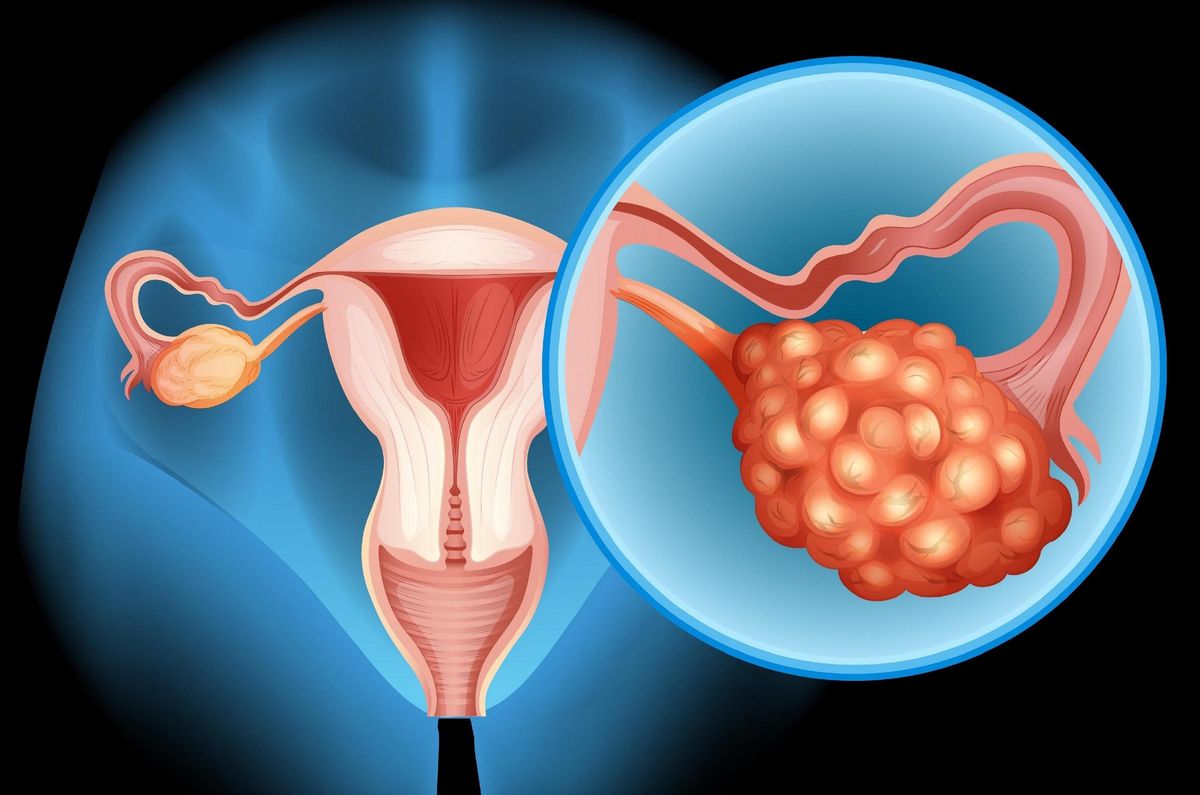 Cervical Cancer