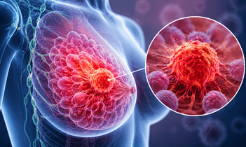 Breast Cancer