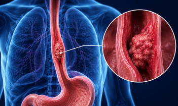 Esophagus Cancer