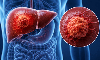 Liver Cancer