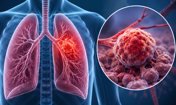 Lung cancer