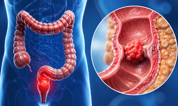 Colon & Rectal Cancer
