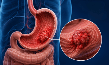Stomach Cancer